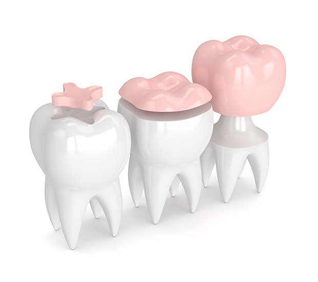 Doral Dental Inlays and Onlays