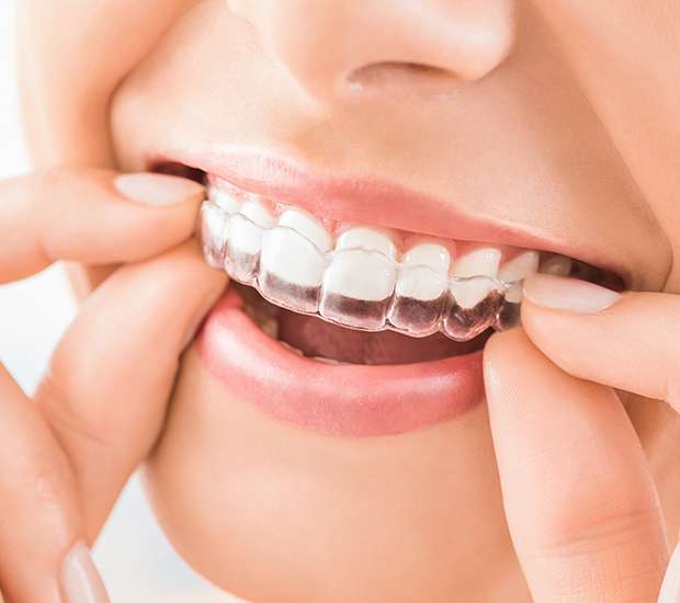 Doral Does Invisalign Really Work