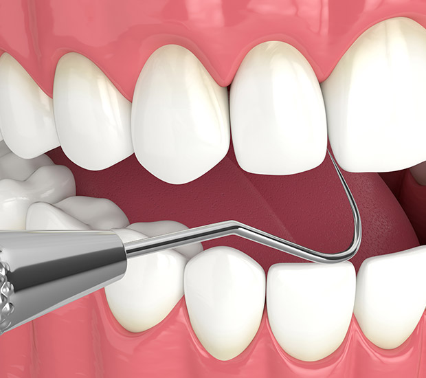 Doral Interactive Periodontal Probing